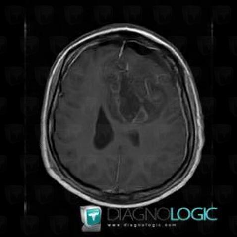 Oligodendroglioma, Cerebral hemispheres, MRI