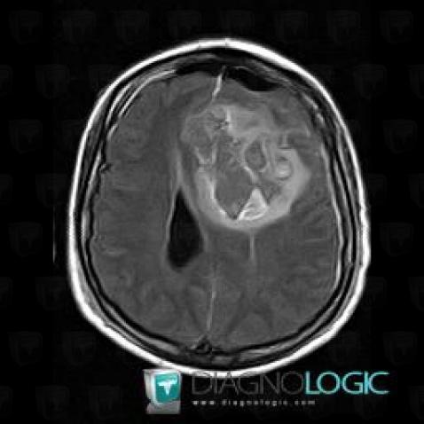 Oligodendroglioma, Cerebral hemispheres, MRI