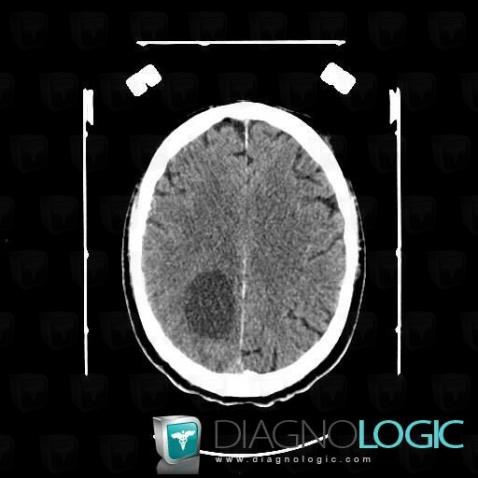 Oligodendroglioma, Cerebral hemispheres, Ventricles / Periventricular region, CT