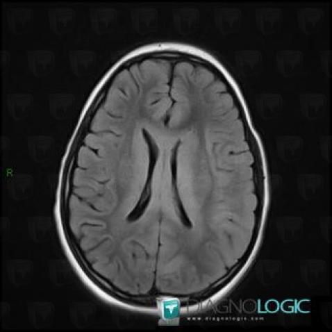 Oligodendroglioma, Corpus callosum, MRI