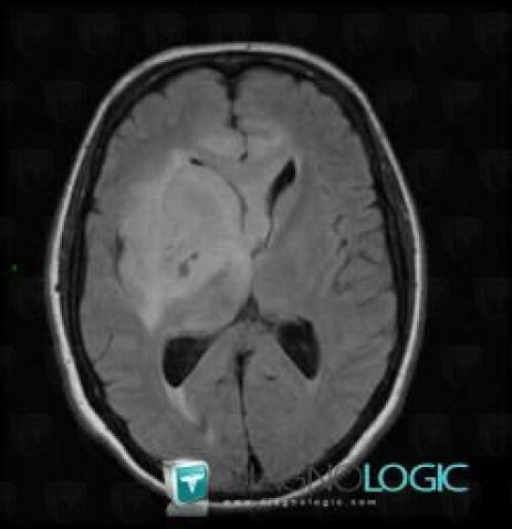 Oligodendroglioma, Corpus callosum, MRI