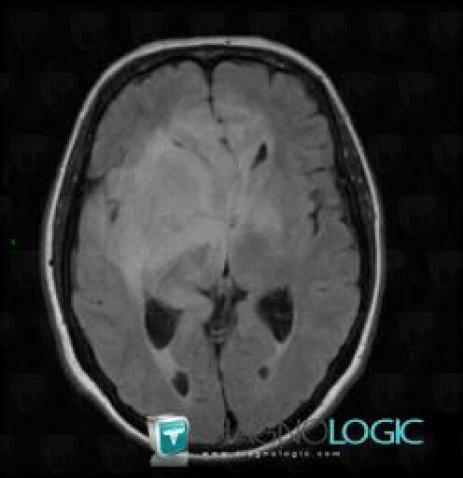 Oligodendroglioma, Ventricles / Periventricular region, MRI