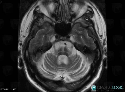 Olivo ponto cerebellar atrophy, Brainstem, MRI