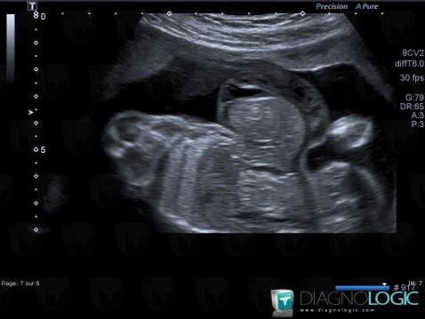 Omphalocèle, Paroi abdominale, Echographie