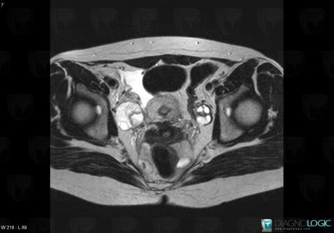 Oophoritis, Adnexa / Ovary fallopian tube, MRI