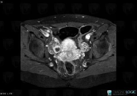 Oophoritis, Adnexa / Ovary fallopian tube, MRI