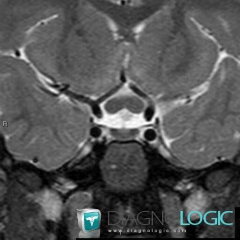 Optic nerve glioma, Eye, MRI