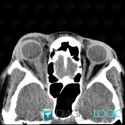 Optic neuritis, Eye, CT