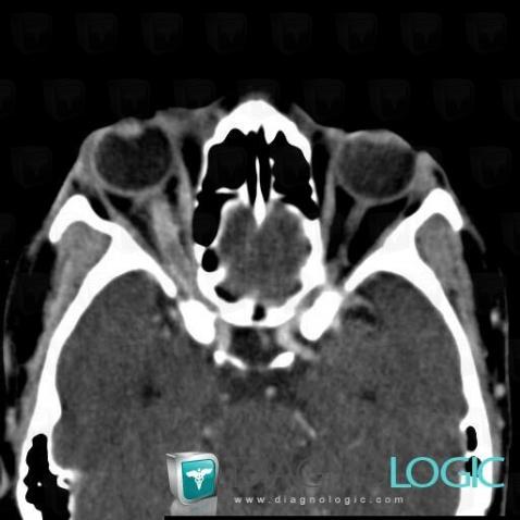 Optic neuritis, Optic nerve, Eye, CT