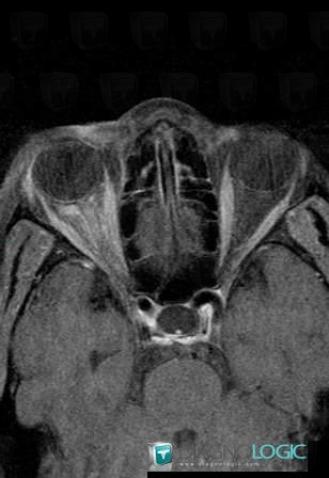 Optic neuritis, Optic nerve, Eye, MRI