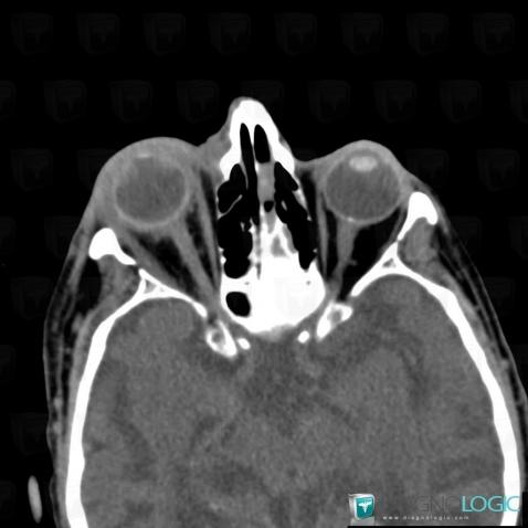 Orbital cellulitis, Eye, CT