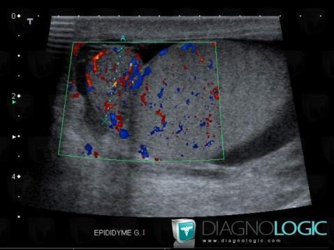 Orchi-épididymite, Scrotum, Echographie