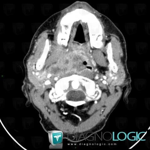 Orophagyngeal neoplasm, Deep facial spaces, CT