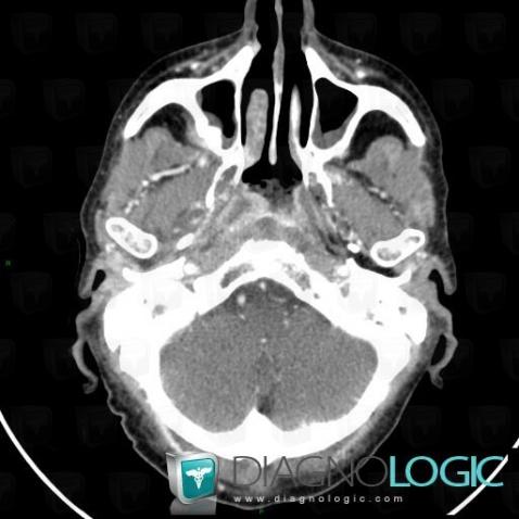 Orophagyngeal neoplasm, Deep facial spaces, CT