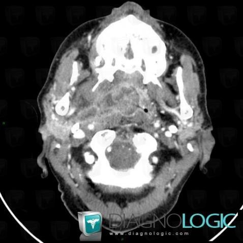 Orophagyngeal neoplasm, Nasal cavity / Nasopharynx, Deep facial spaces, CT