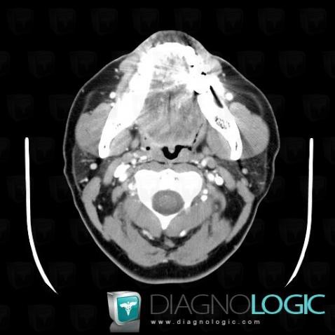 Orophagyngeal neoplasm, Oropharynx / Floor-mouth, CT