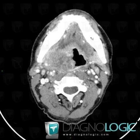 Orophagyngeal neoplasm, Oropharynx / Floor-mouth, CT