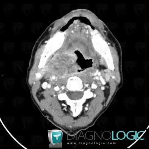 Orophagyngeal neoplasm, Oropharynx / Floor-mouth, Pharyngolarynx, CT