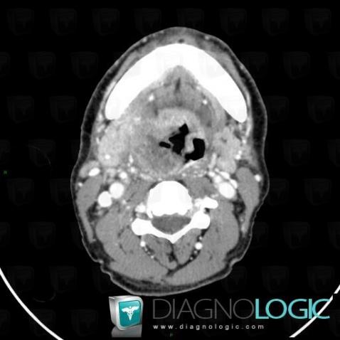 Orophagyngeal neoplasm, Pharyngolarynx, CT