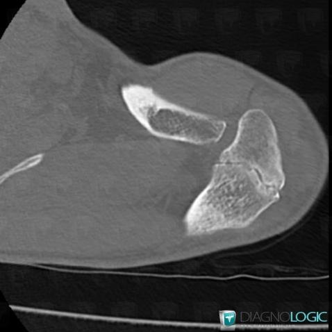 Os acromiale, Scapula, CT