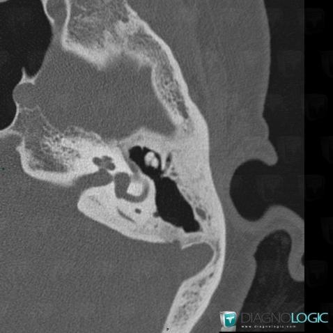 Ossicular chain dislocation, Middle ear, CT