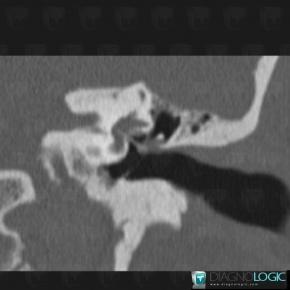 Ossicular Prosthesis /  Ear, Inner ear, CT