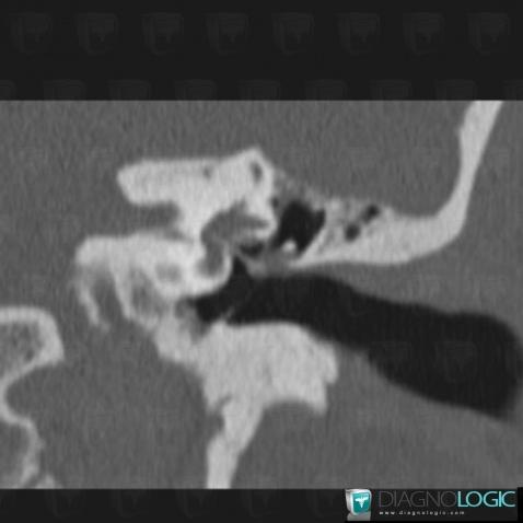 Ossicular Prosthesis /  Ear, Inner ear, CT