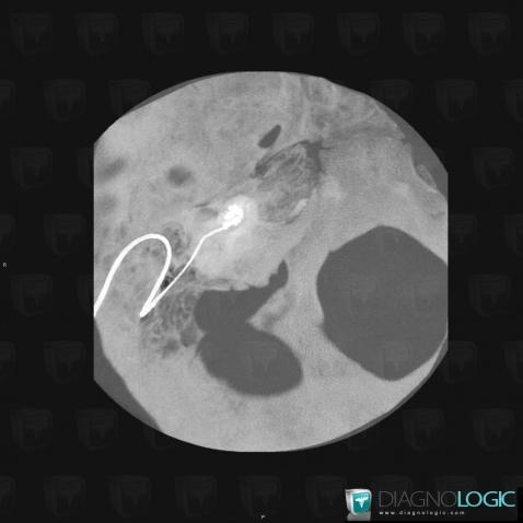 Ossicular Prosthesis /  Ear, Inner ear, CT