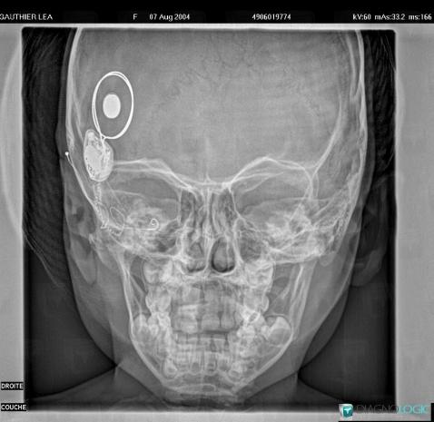 Ossicular Prosthesis /  Ear, Inner ear, X rays