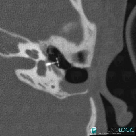 Ossicular Prosthesis /  Ear, Middle ear, CT