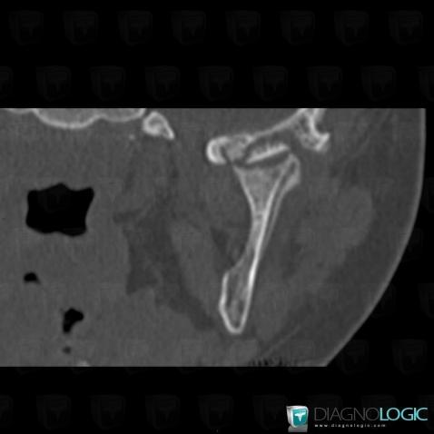 Osteite, Mandibule, Scanner