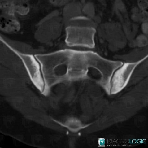 Osteitis condensans ilii, Sacro iliac joint, CT