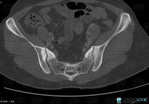 Osteitis condensans ilii, Sacro iliac joint, CT