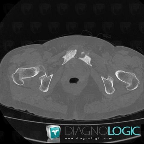 Osteitis pubis, Pubic symphysis, CT