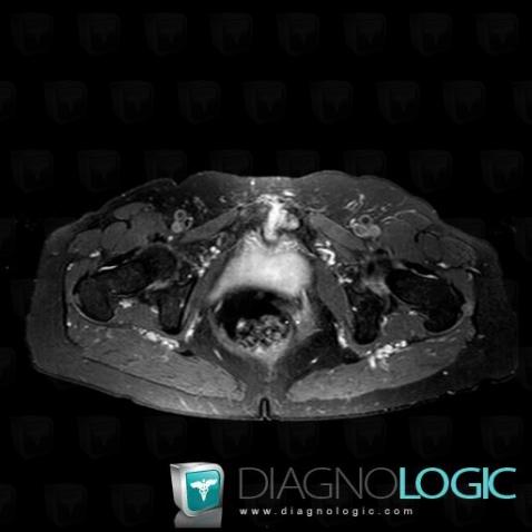 Osteitis pubis, Pubic symphysis, MRI