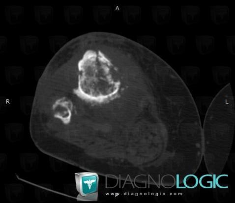 Radiology case : Osteitis (CT) - Diagnologic