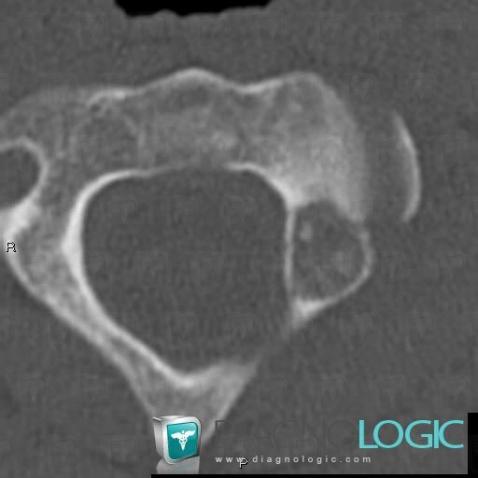 Osteoblastoma, Vertebral body / Disk, CT