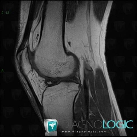 Osteochondral lesion , Femorotibial joints - Intercondylar notch, MRI