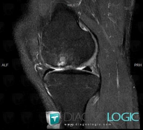 Osteochondral lesion , Femur - Distal part, MRI