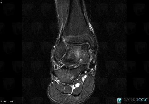 Osteochondral lesion , Talus, MRI