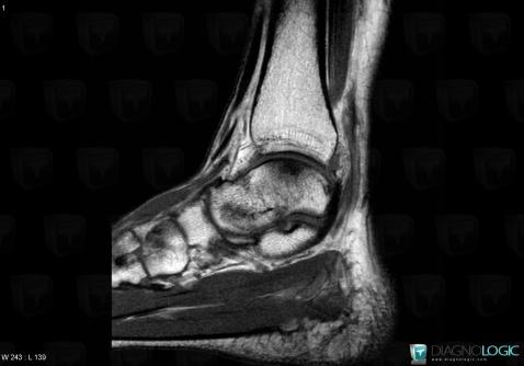 Osteochondral lesion , Talus, MRI