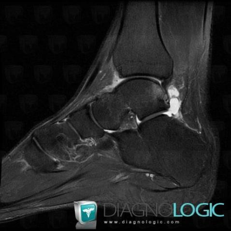 Osteochondral lesion , Talus, MRI