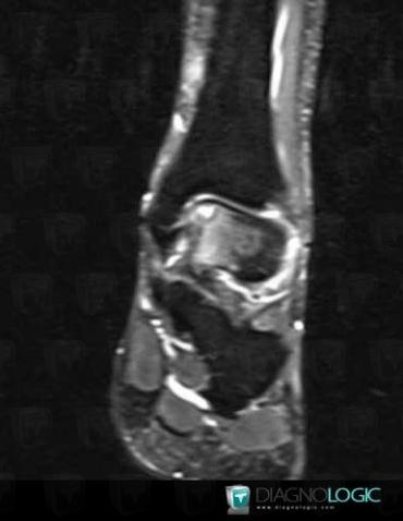 Osteochondral lesion , Talus, MRI