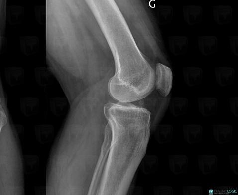 Osteochondral lesion , Tibia - Proximal part, Femorotibial joints - Intercondylar notch, X rays