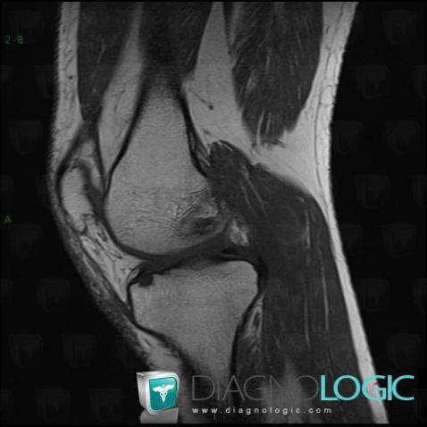 Osteochondral lesion , Tibia - Proximal part, MRI