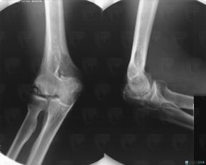 Osteochondritis dissecans, Humerus - Distal part, X rays