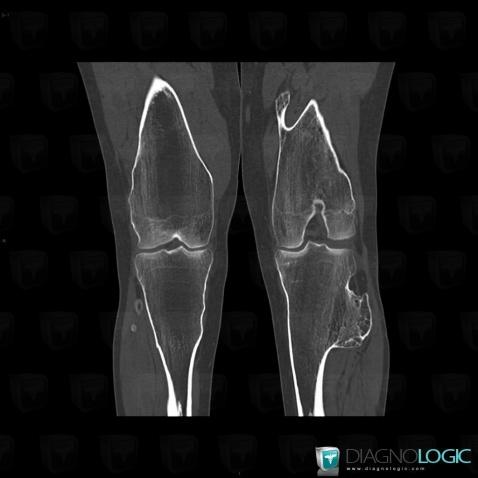 Osteochondroma, Femur - Distal part, CT