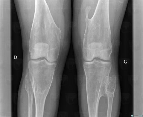 Osteochondroma, Femur - Distal part, Tibia - Proximal part, X rays