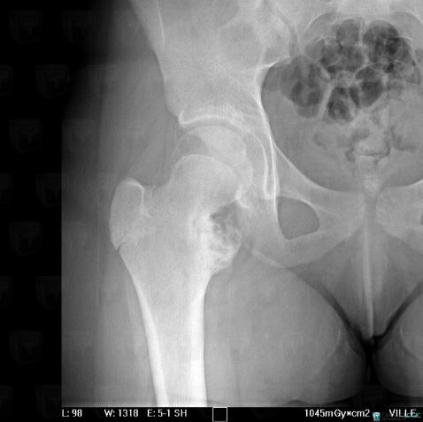 Osteochondroma, Femur - Proximal part, X rays