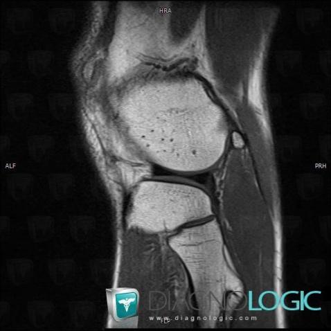 Osteochondroma, Fibula - Proximal part, MRI